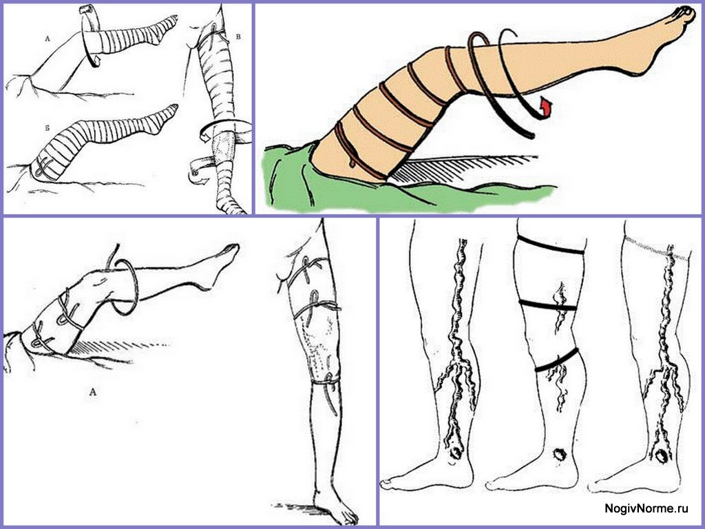 Пробы При Варикозной Болезни