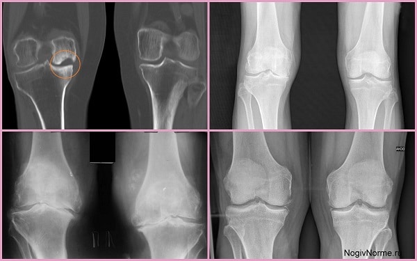 Двусторонний гонартроз степени. Степени гонартроза рентген. Гонартроз коленного сустава 2.