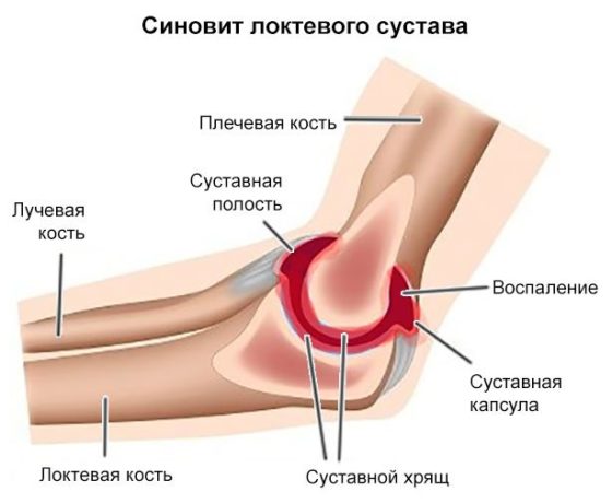 Синовит является противопоказанием к применению Адгелона