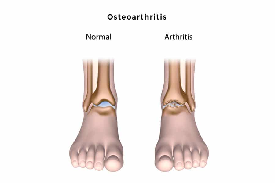 osteoarthritis aktív)