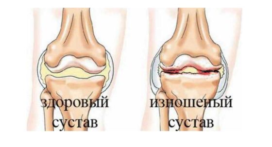 Хондроитин помогает восстановить поврежденный сустав