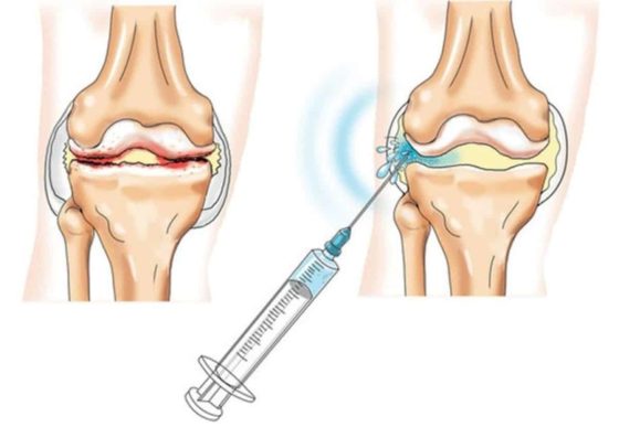 Препарат вводят внутрь поврежденного сустава