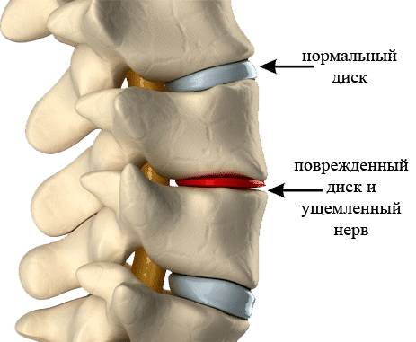 Остеохондроз позвоночника - одно из показани к применению Артогистана