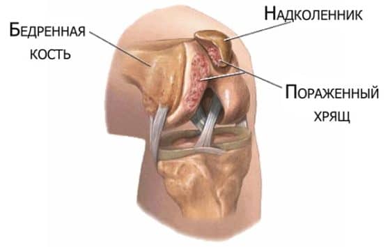 Кондронова От Чего Помогает