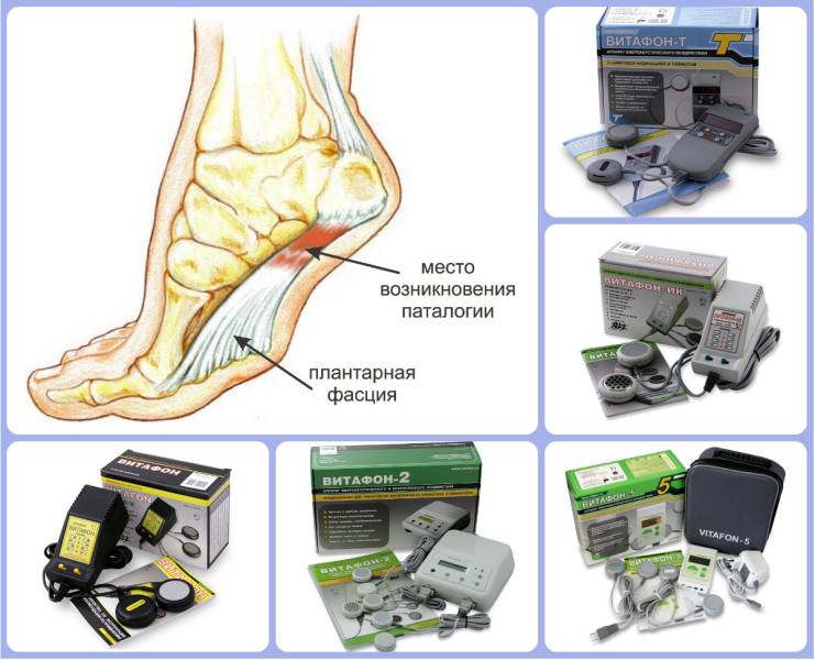 Витафон при пяточной шпоре схема лечения