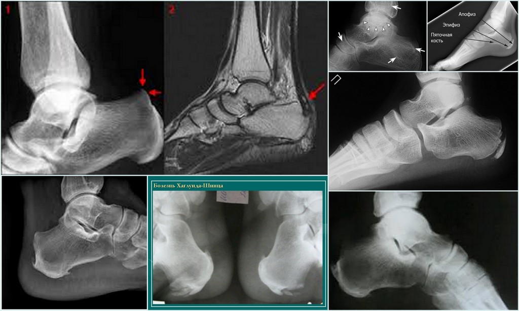 Шипы в пятке фото рентген до и после