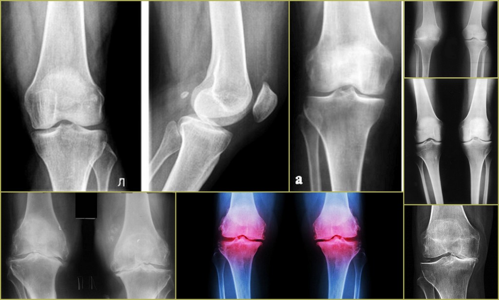 Деформирующий артроз сустава. Деформирующий остеоартроз 2 степени. Гонартроз коленного сустава степени. Деформирующий артроз коленного сустава рентген.