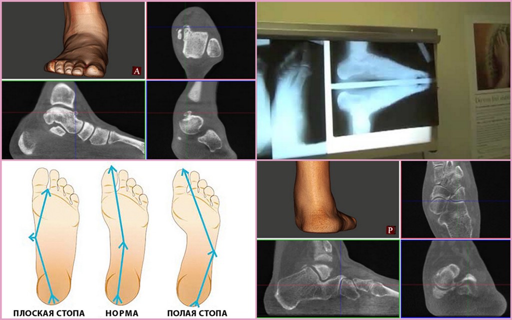 Как правильно делать рентген стоп. Продольное плоскостопие рентген. Поперечное плоскостопие рентген. Плоскостопие 3 степени рентген. Поперечное плоскостопие рентгенодиагностика.