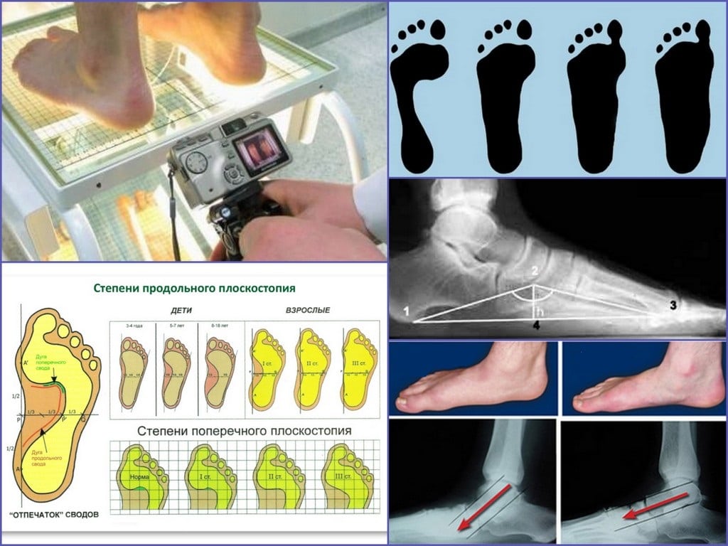 Плоскостопие 3 степени фото как определить