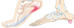 Плантарный фасциит и пяточная шпора