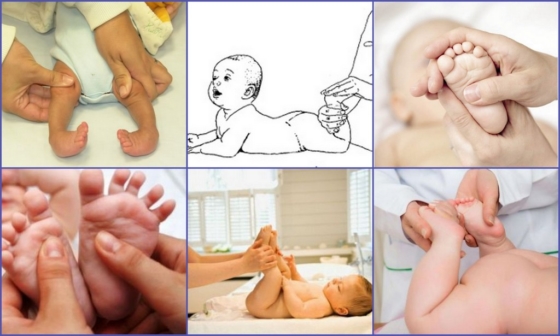 Гимнастика при косолапии у новорожденного