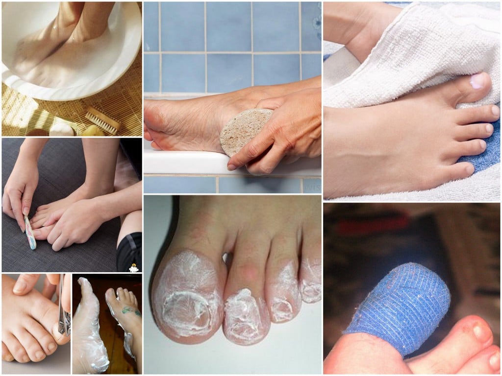 Чем размягчить ногти на ногах у пожилых людей перед стрижкой в домашних условиях фото пошагово