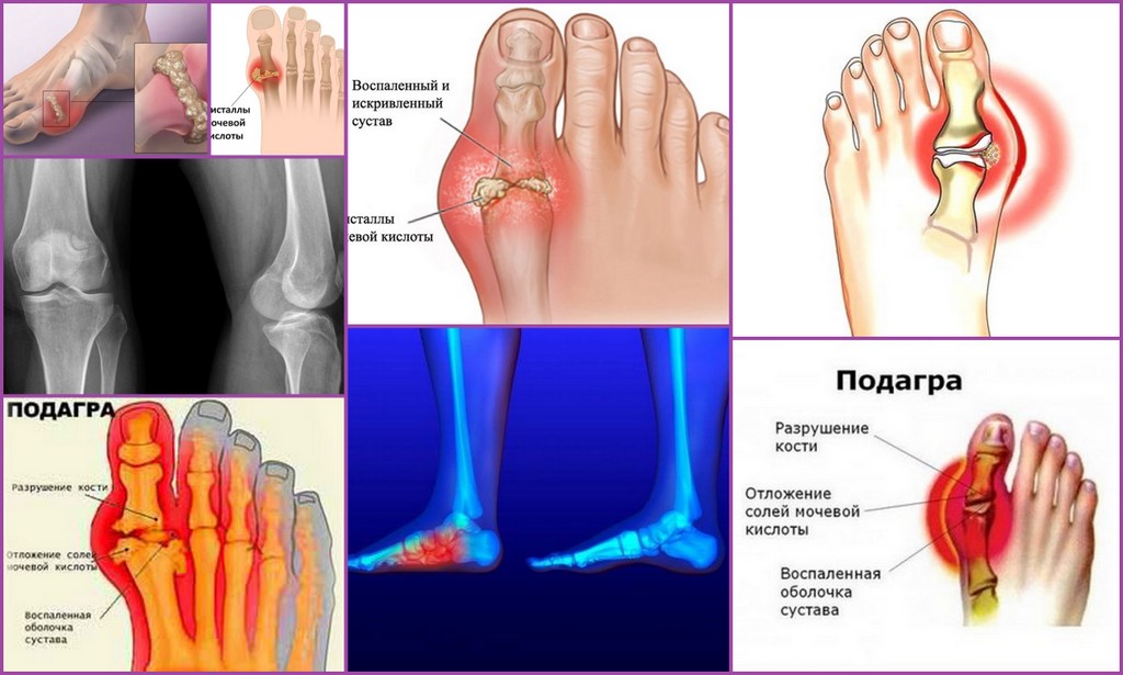 Заболевания подагра симптомы и причины. Подагрический и ревматоидный артрит. Подагрический артрит симптомы. Артритическая подагра.