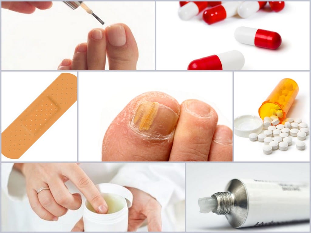 Как вылечить ногтевую. Грибок ногтей на ногах лекарство. Средство от грибков на ногтях. Лекарства для грибок для ногт.