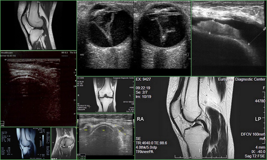 Узи коленного сустава адреса. Разрыв мениска коленного сустава на УЗИ. УЗИ анатомия коленного сустава. Повреждение мениска коленного сустава УЗИ. УЗИ мягких тканей коленного сустава.