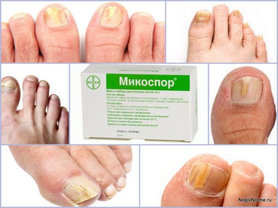 Набор Микоспор для лечения ногтей: инструкция по применению, цена .