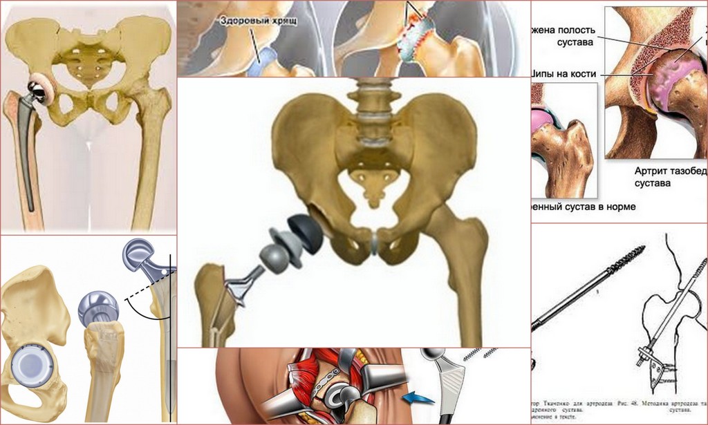 Коксартроз презентация травматология