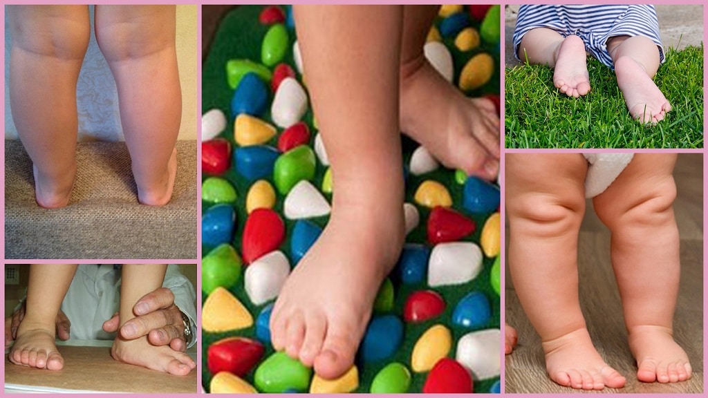 Плоскостопие фото стопы у ребенка