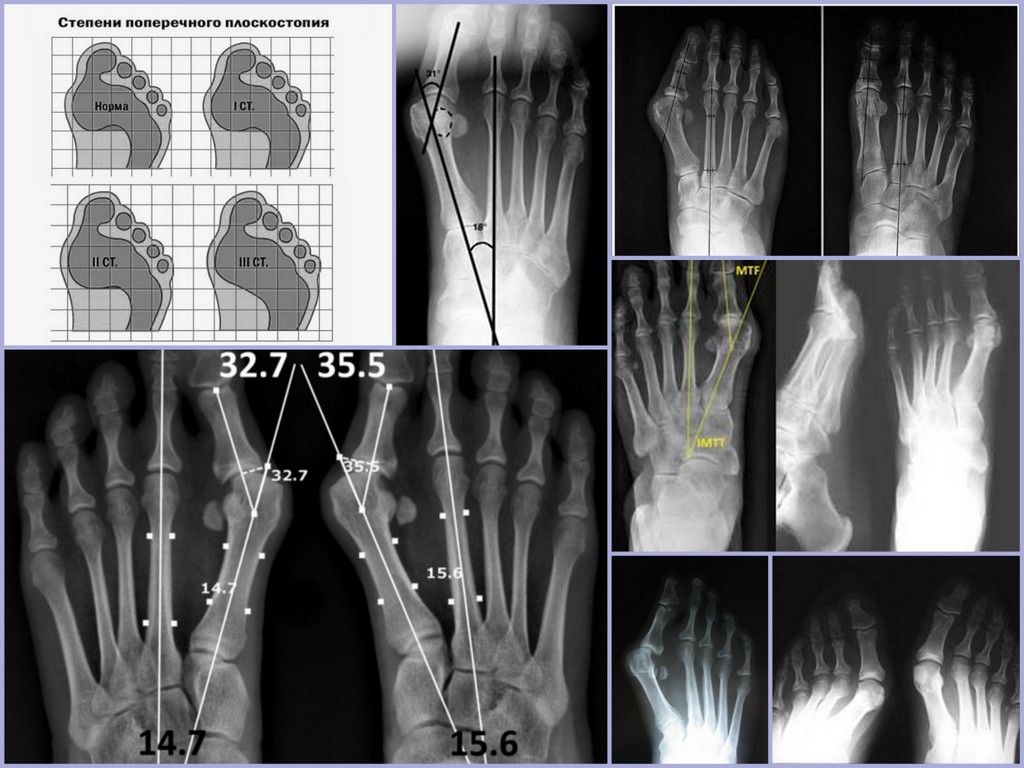 Поперечное плоскостопие степени. Поперечное плоскостопие 3 степени рентген. Поперечное плоскостопие рентген измерение. Поперечное плоскостопие рентген степени. Поперечное плоскостопие рентгенодиагностика.