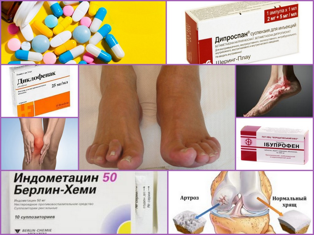 Лечение артрита и артроза препараты
