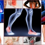 Признаки мигрирующей боли в суставах и мышцах