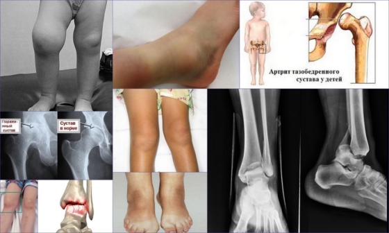 Проявления ревматоидного артрита у детей