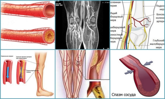 Патологические процессы в сосудах при облитерирующем эндартериите