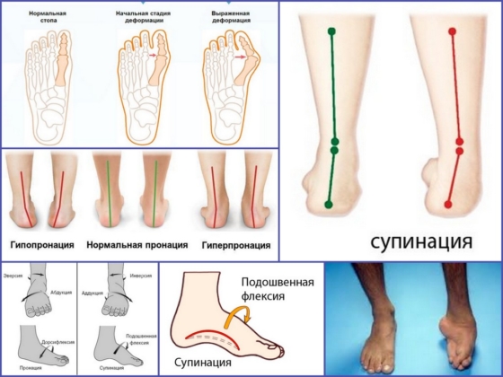 Пронация и супинация стопы у детей