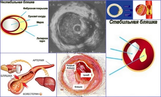 Фото атеросклеротические бляшки
