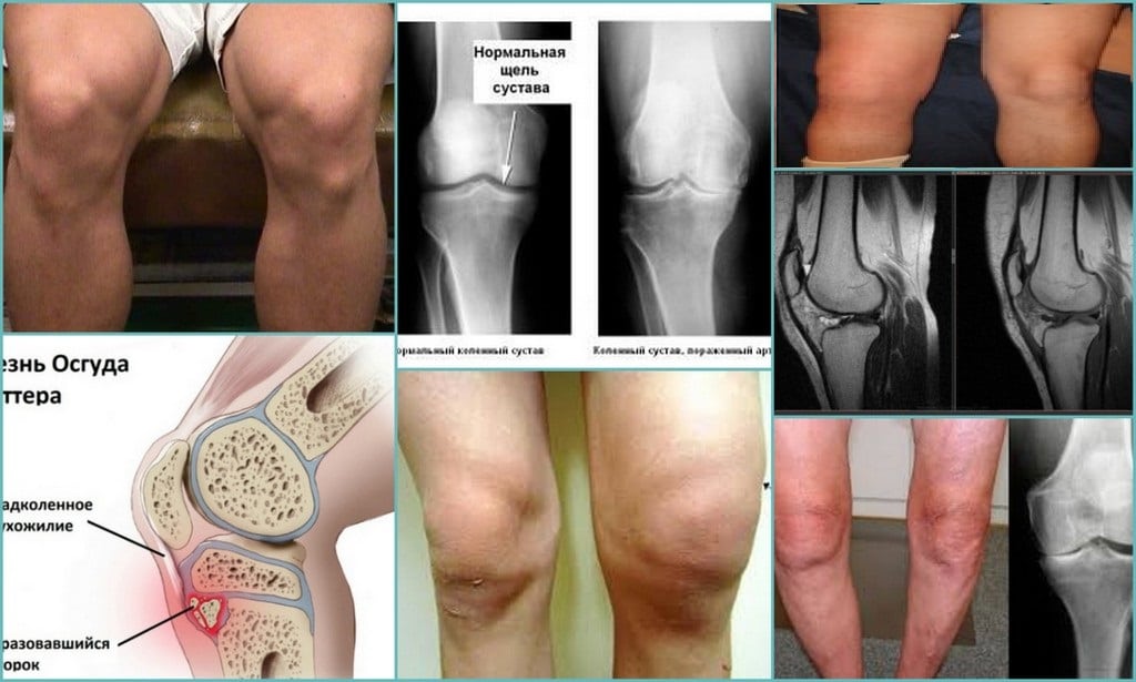 Разновидности болезней колена и их проявления 