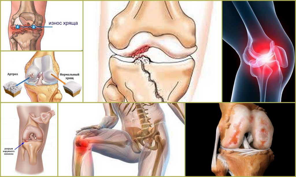 Артроз картинки коленный