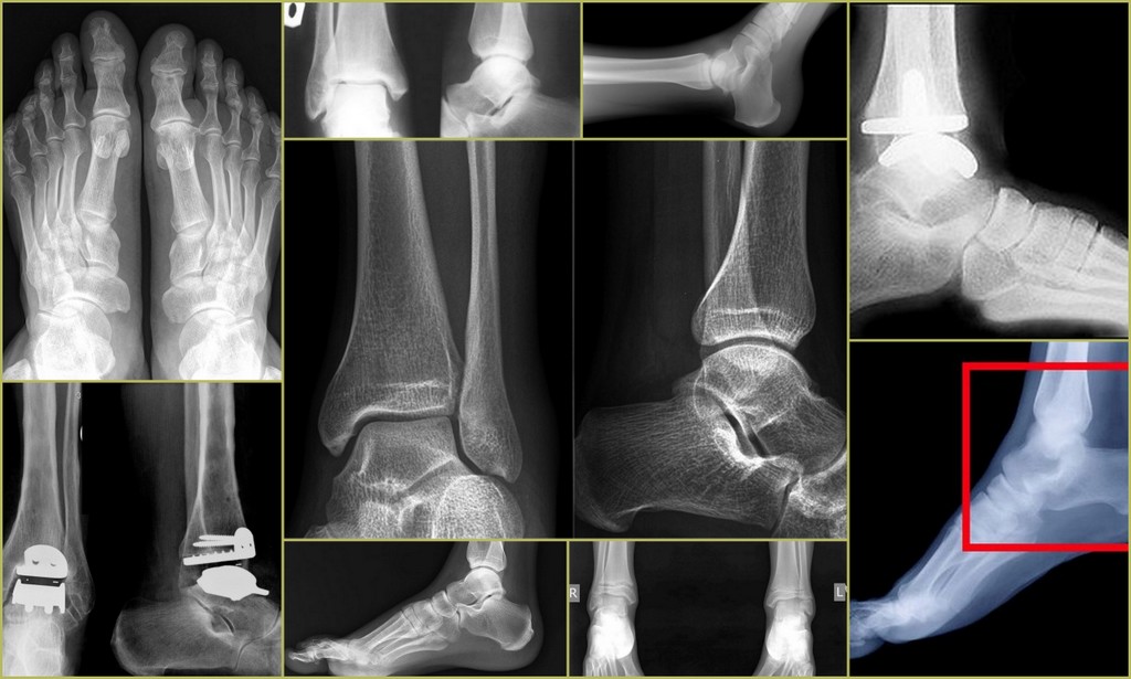 Голеностопный сустав левой ноги. Кости стопы снимок рентген. Остеоартроз голеностопного сустава рентген. Рентген голеностопного сустава в прямой проекции. Перелом наружной лодыжки рентген.