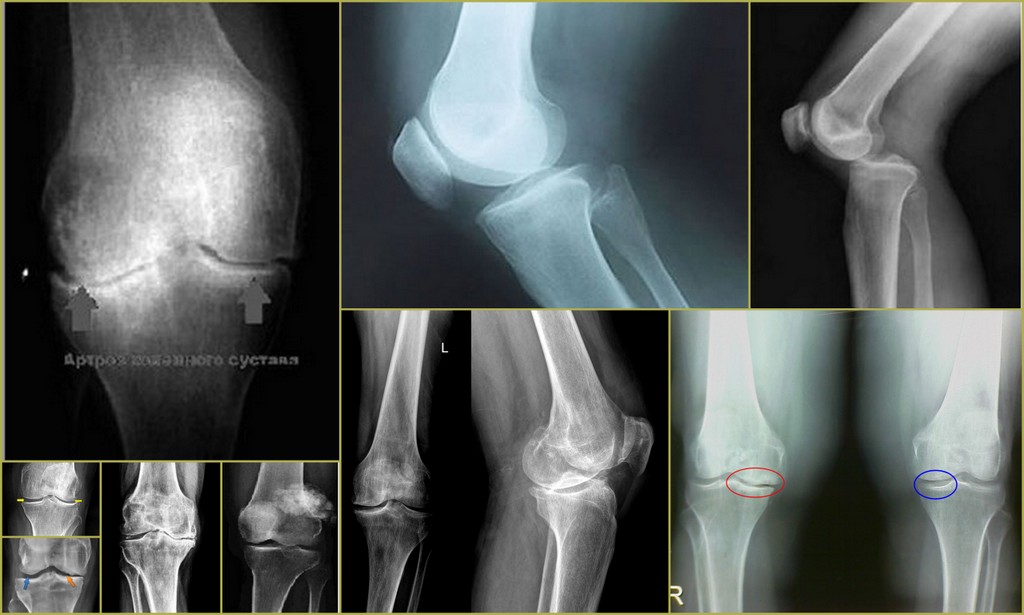 Рентген колена. Патология коленного сустава рентген. Рентген здорового коленного сустава. Менископатия коленного сустава рентген. Артрит коленного сустава рентген.