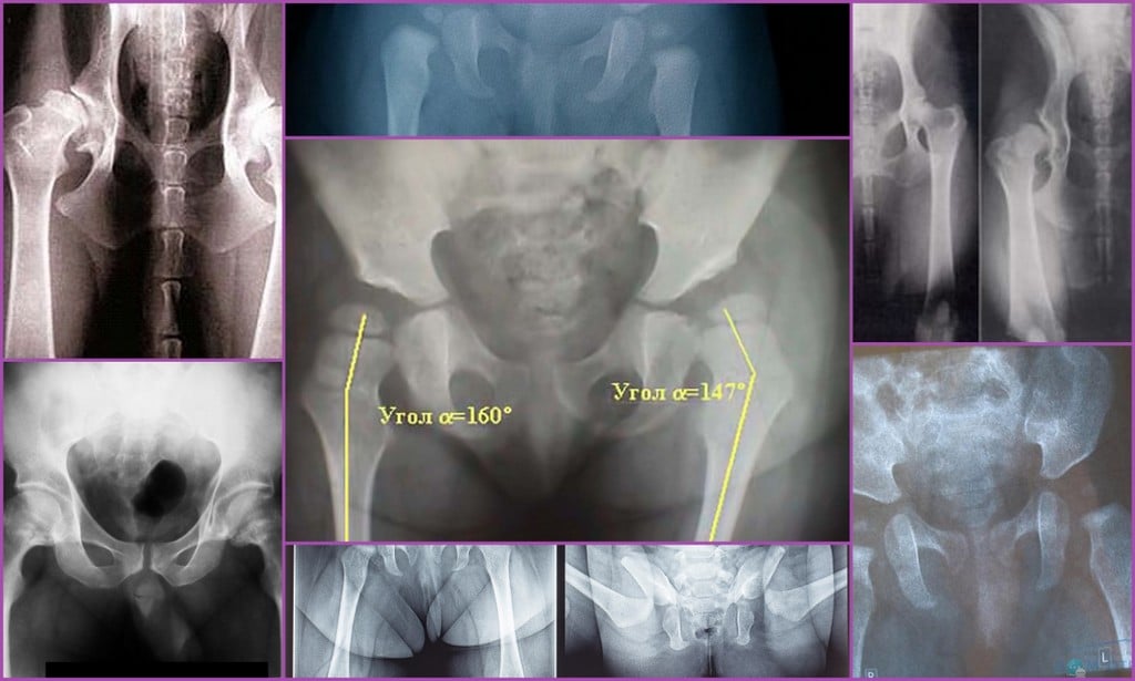 Как делают рентген тазобедренного сустава фото взрослых