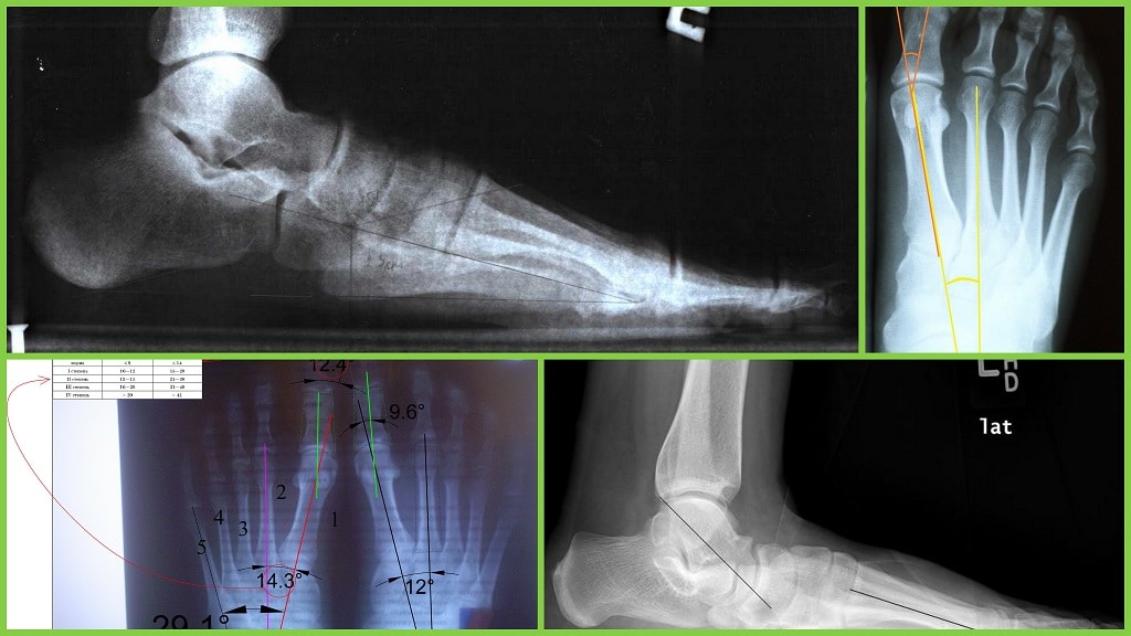 Рентген стопы в двух проекциях фото