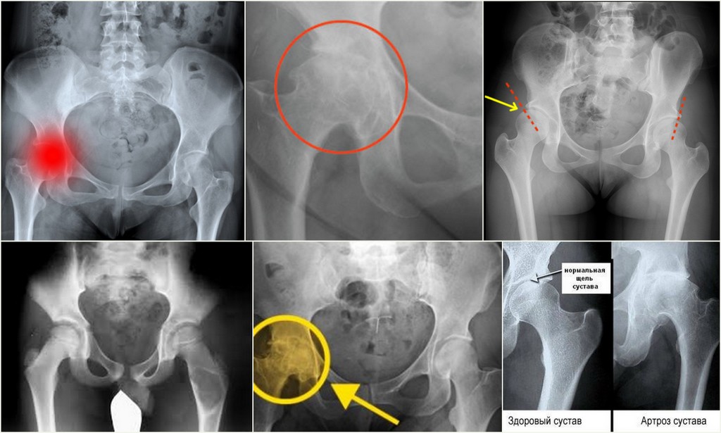 Стадии коксартроза тазобедренного сустава по рентгену фото