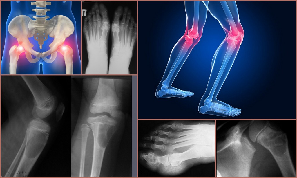 Ревматический полиартрит рентгенологическая картина