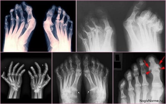 Ревматический полиартрит рентгенологическая картина