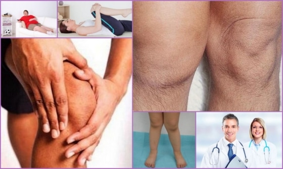 Симптоматика артроза колена