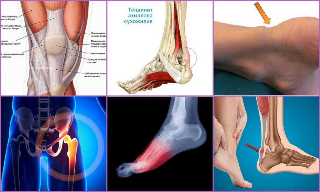 Тендиноз ахилловых сухожилий что это. Тендинит ахиллова стопы. Тендинит сухожилия большеберцовой мышцы. Тендовагинит голеностопного сустава операции. Воспаление сухожилий коленного сустава.