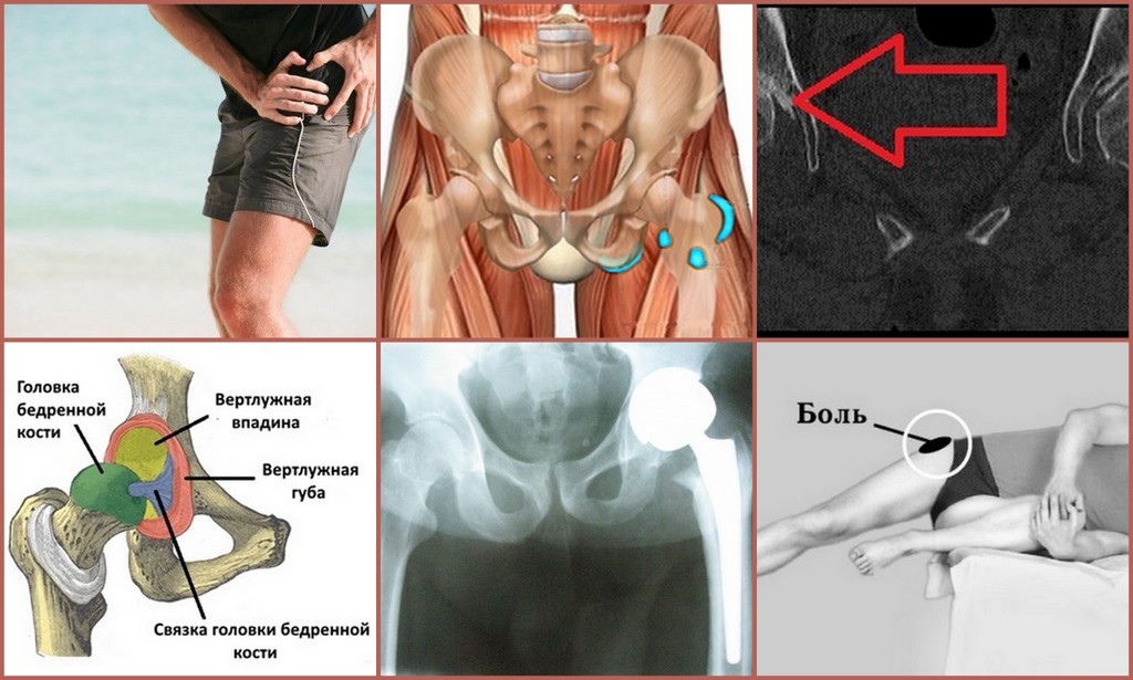 Где болит при коксартрозе фото
