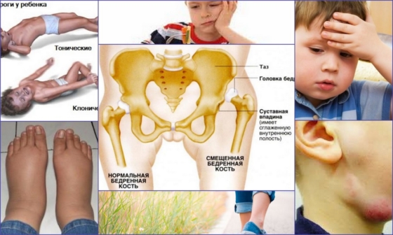 Симптомы ревматоидного артрита у детей