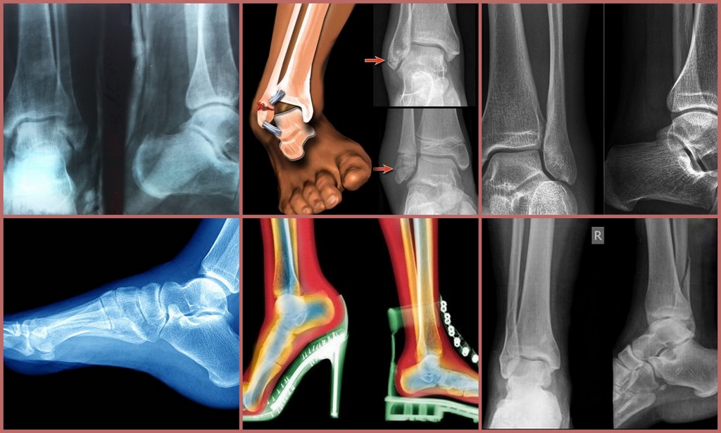Голеностопный сустав левой ноги. Подвывих голеностопа рентген. Голеностопный сустав рентген норма. Перелом лодыжки рентген. Снимок голеностопного сустава в норме.