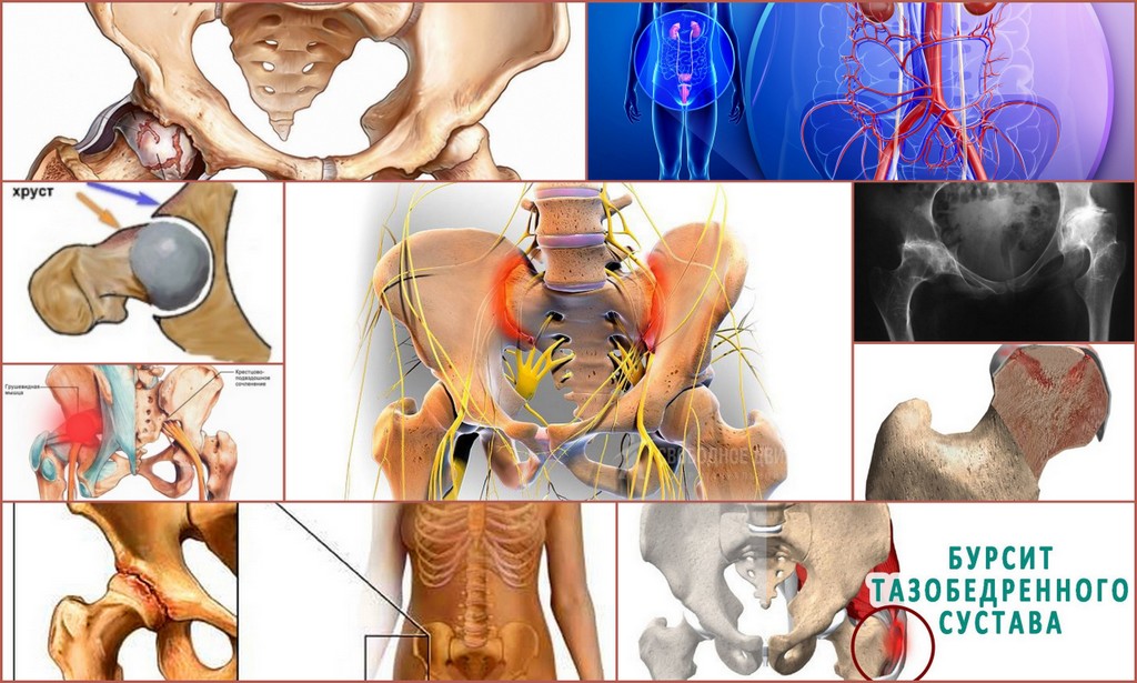Тазобедренный сустав симптомы болезни лечение у женщин фото и лечение