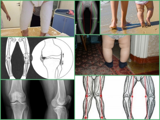 Варусная деформация голени у детей до года