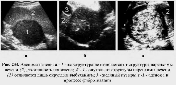 Образование в печени. Гепатоцеллюлярная аденома печени УЗИ. Печеночно клеточная аденома УЗИ. Новообразование в печени на УЗИ.