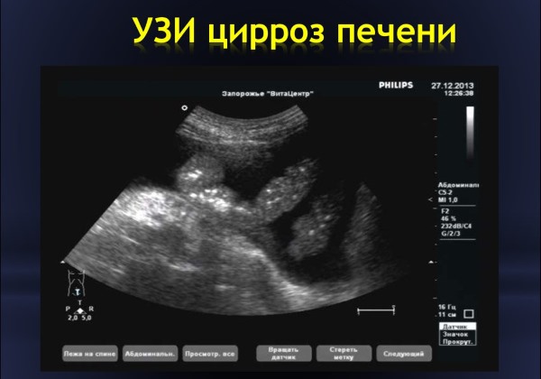 Узи печени что показывает камень в желчном пузыре можно ли раздробить