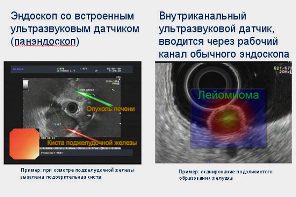 Эндосфера результаты фото