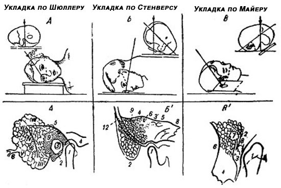 Укладка по шюллеру рентген фото