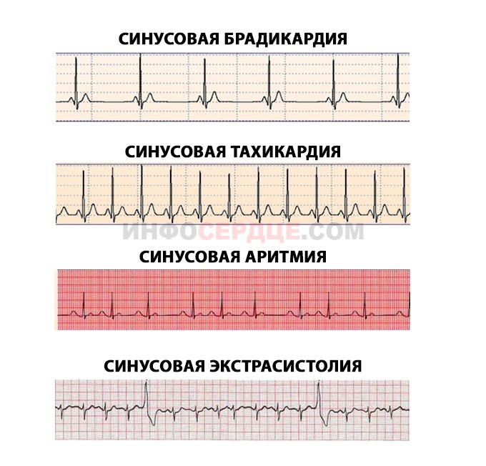 Синусовая аритмия это. Синусовая тахикардия синусовая брадикардия. Синусовая тахикардия сердца ЭКГ. Синусовая аритмия тахикардия. ЭКГ ритм синусовая аритмия.